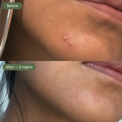 Hydrocolloid Acne Patches