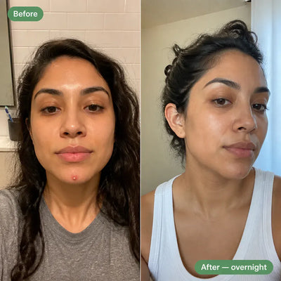 Hydrocolloid Acne Patches
