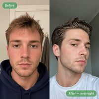 Hydrocolloid Acne Patches